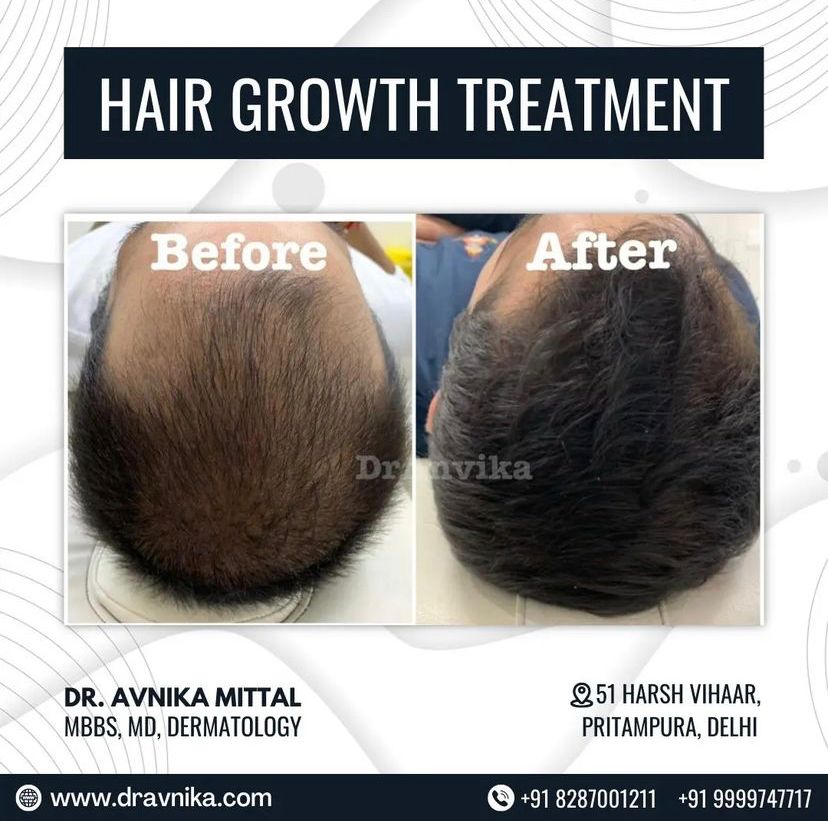 Hairfall Treatment : PRP & Mesotherapy