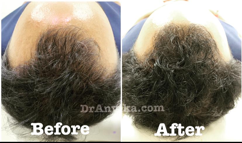 Hairfall Treatment : PRP & Mesotherapy