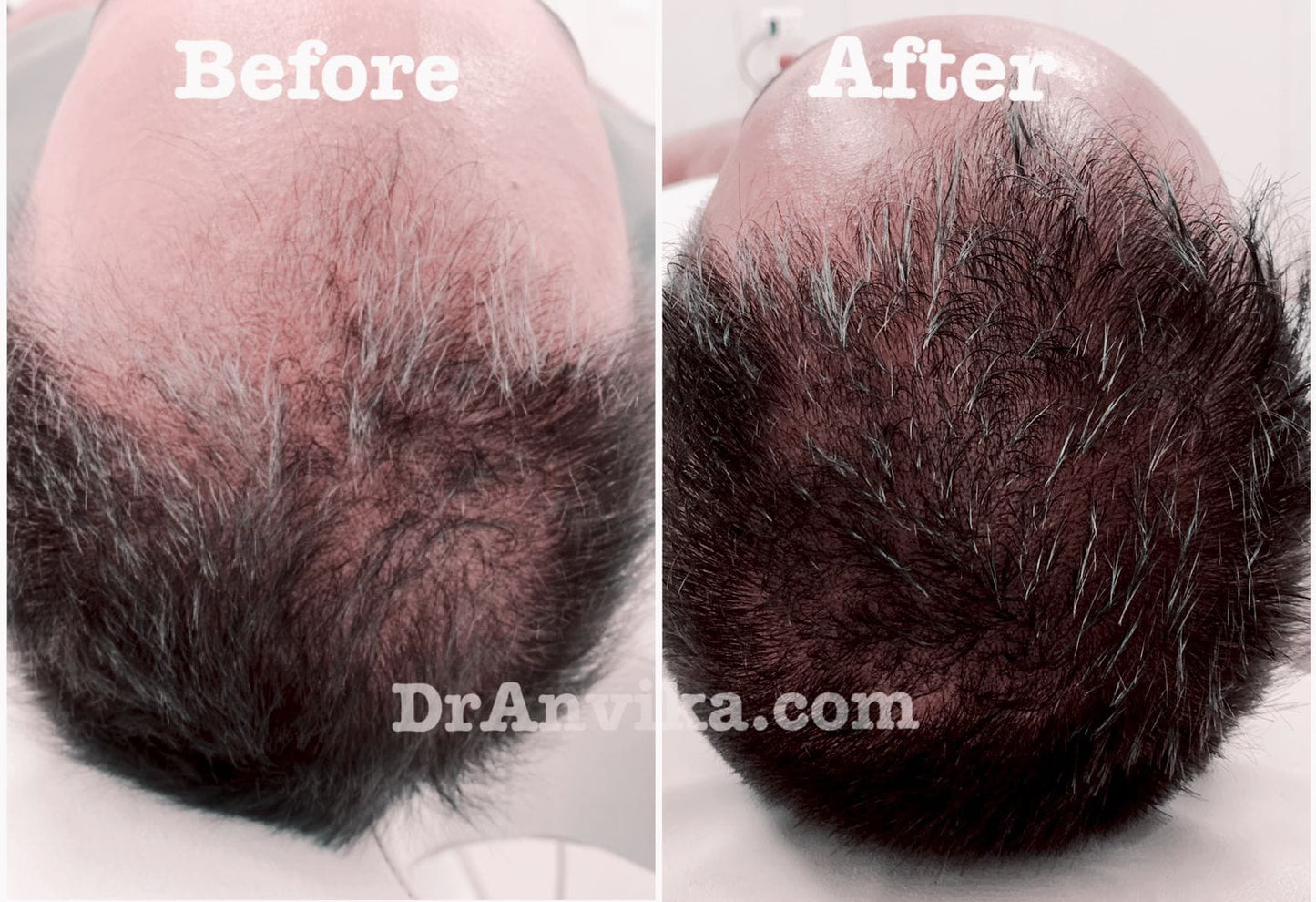 Hairfall Treatment : PRP & Mesotherapy