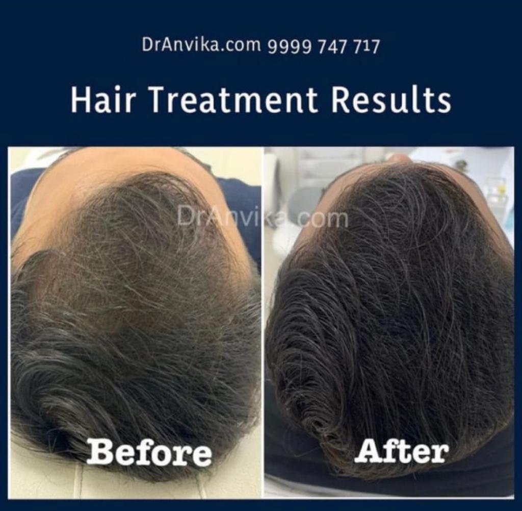 Hairfall Treatment : PRP & Mesotherapy