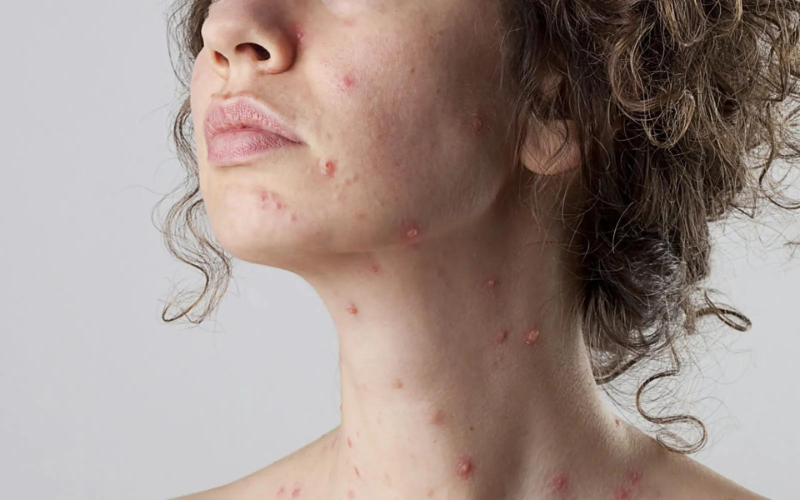 CHICKEN POX SCARS - Dr Anvika