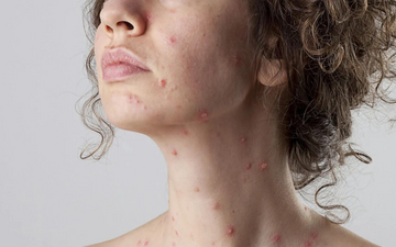 CHICKEN POX SCARS - Dr Anvika