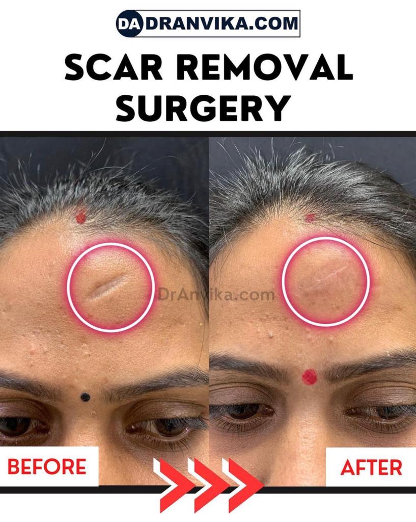 Scars -  Trauma scars reduction with Laser or Surgery