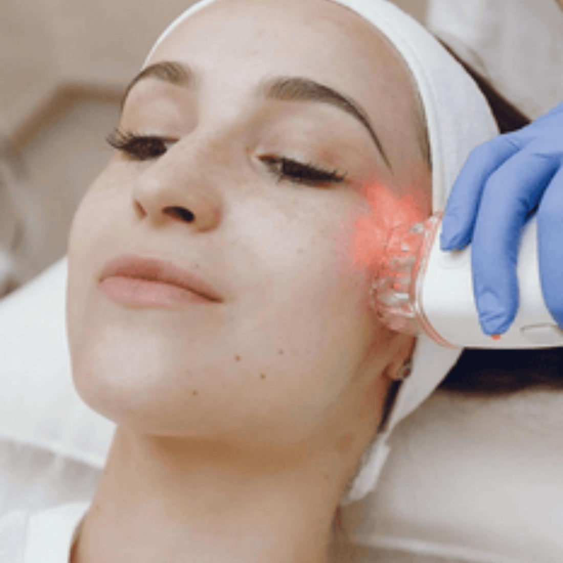 Acne Scar Reduction with Laser & Dermabrasion