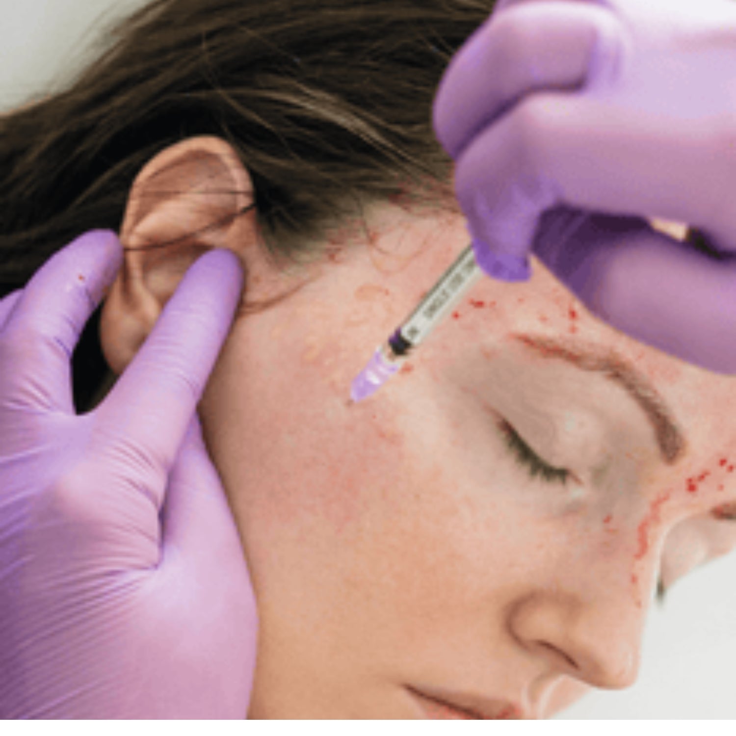 Skin Glow : Vampire Facial (Microneedling & PRP) and Laser Toning(ND:Yag Q Switched Laser )