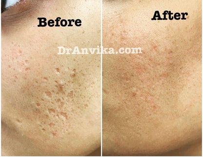 Acne Scar Reduction with Laser & Dermabrasion