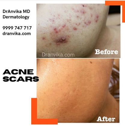 Acne Scar Reduction with Laser & Dermabrasion