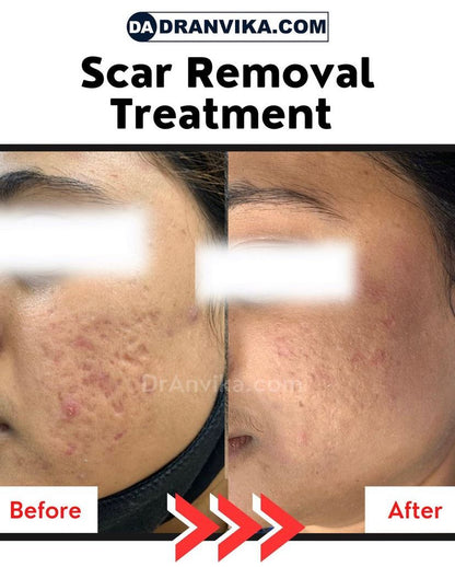 Acne Scar Reduction with Laser & Dermabrasion