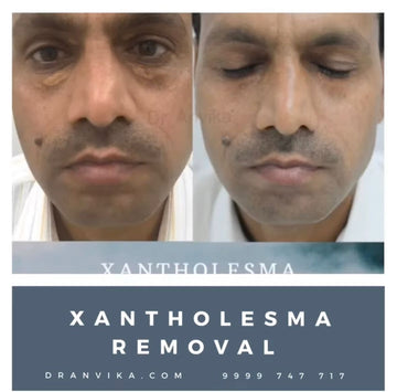 XANTOLESMA REMOVAL : Fat deposits on eyelids